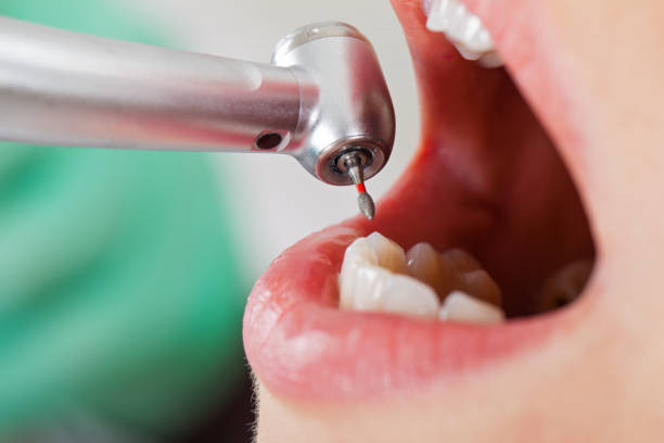Best Emergency Dental Extractions in Ranger, TX